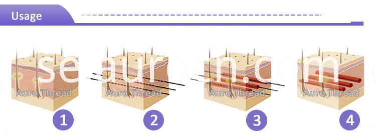 Trådlyftning Thread lifting